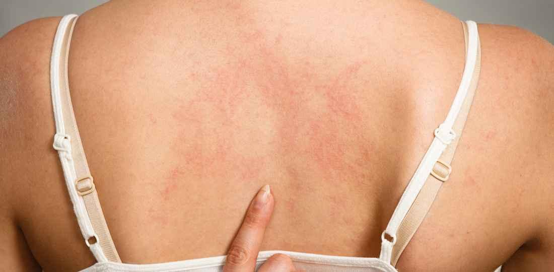 What Causes Dry Skin Patches on Shoulders? Understanding Skin Conditions