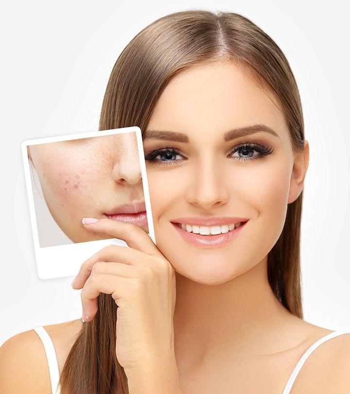 What to Expect During Your First Acne Consultation