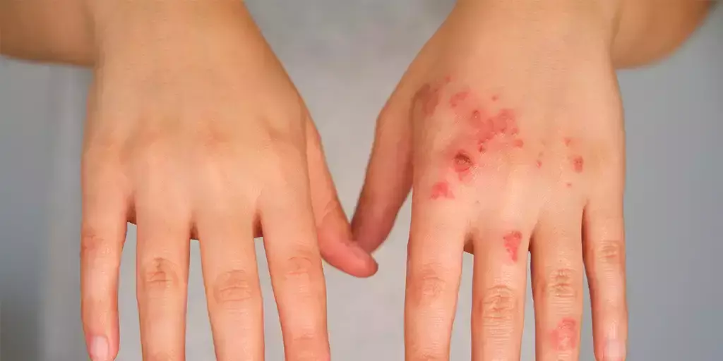 Use of antibiotics in the treatment of skin infections