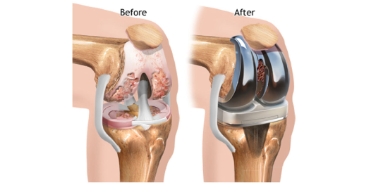 Best Knee Replacement in Jaipur: What to Expect Before, During, and After Surgery