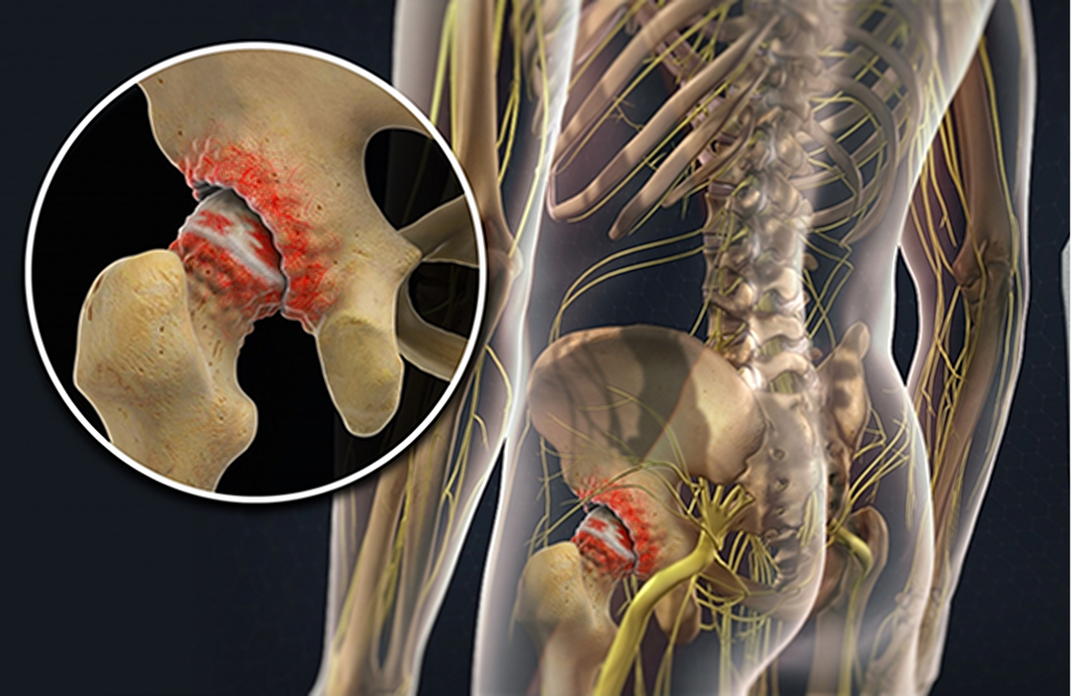 Hip Replacement in Jaipur: What You Need to Know Before Surgery