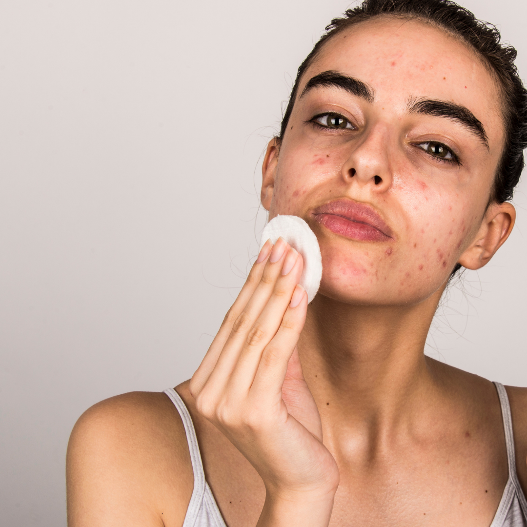 Isotroin 20mg Explained: Your Path to Pimple-Free Skin