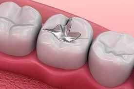 The Complete Guide to Tooth Filling at Zenon Dental Clinic