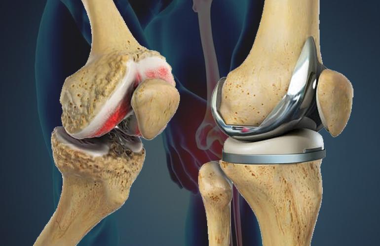 Top Hospitals Offering the Best Knee Replacement in Jaipur