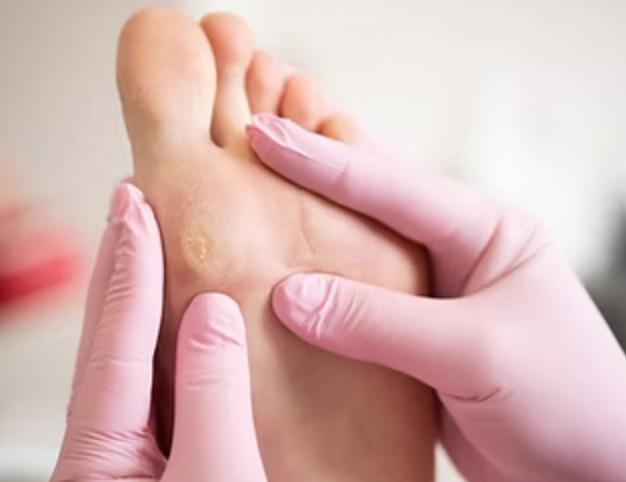 What Is the Best Callus Removal Method in Singapore?