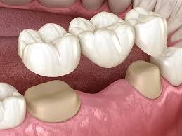 Dental Bridge Dubai: Restore Your Smile with Confidence