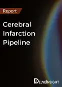 Cerebral Infarction: Mechanistic Insights to Clinical Outcomes
