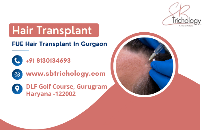 Baldness Concerns Managed with FUE Hair Transplant Surgery