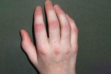 Psoriatic Arthritis Symptoms, Causes, Diagnosis and Treatment
