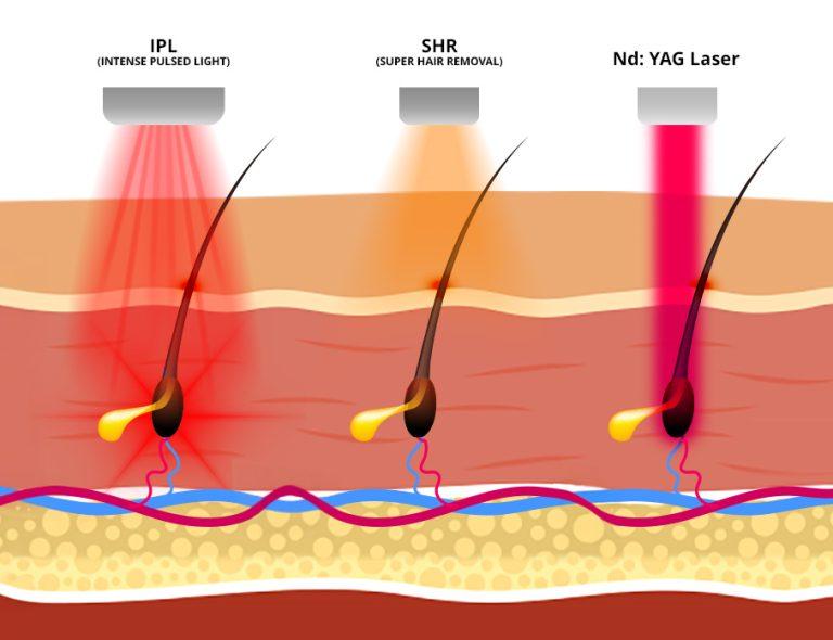 Underarm Laser Hair Removal Singapore: Smooth, Long-Lasting Results