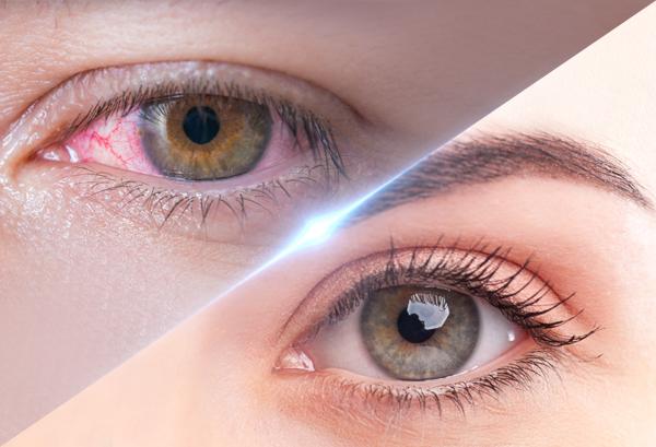 What Is the Best Natural Treatment for Eye Diseases in Dubai?
