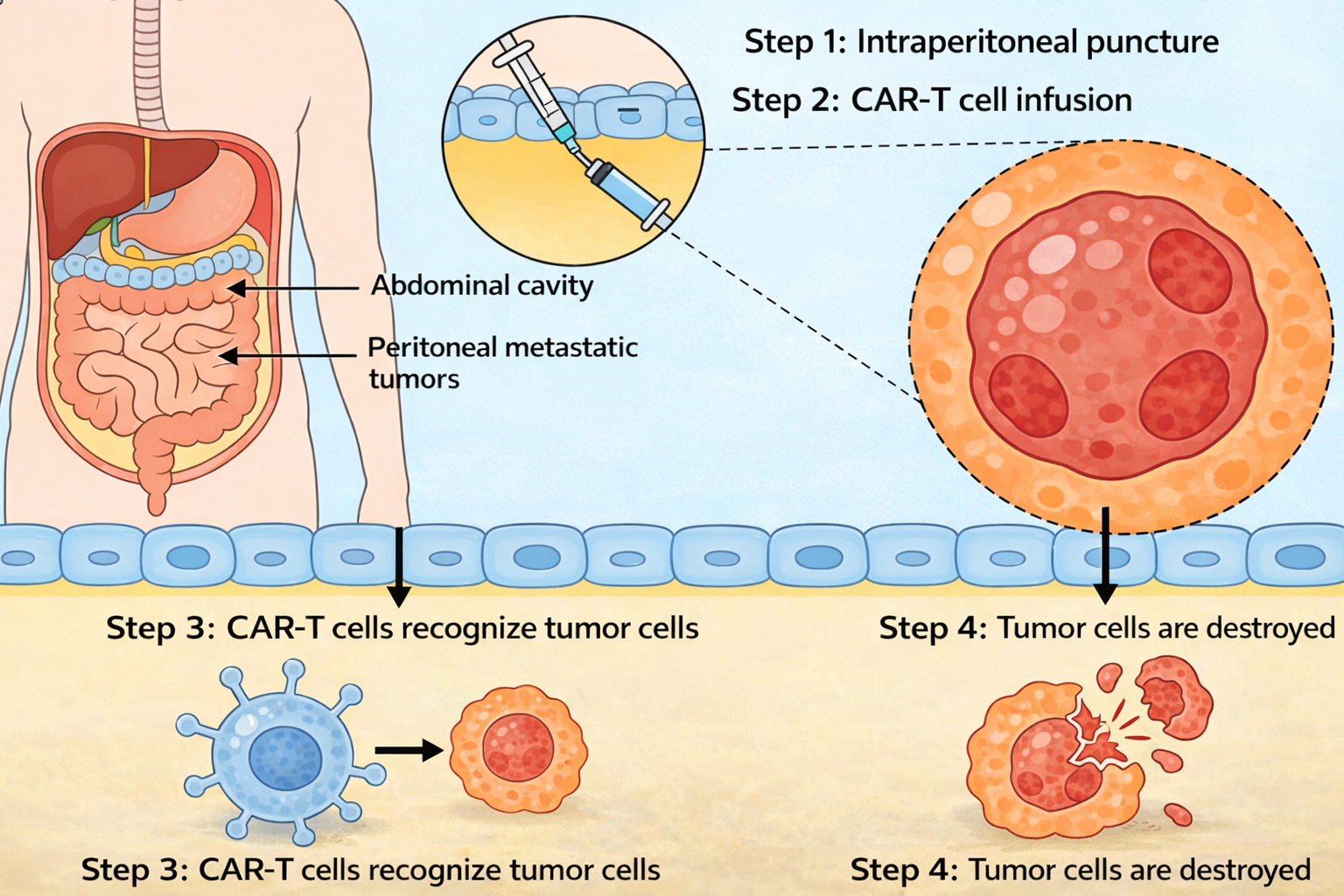 Breaking the 85% Cancer Treatment Bottleneck: Hypoxia-Gated CEA-Targeted CAR-T (PC13) Achieves a Key Breakthrough
